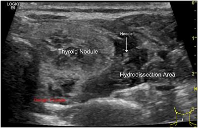 A Novel Strategy for Single-Session Ultrasound-Guided Radiofrequency Ablation of Large Benign Thyroid Nodules: A Pilot Cohort Study